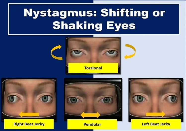nystagmus-shaking-eyes-shifting-eyes-causes-treatment