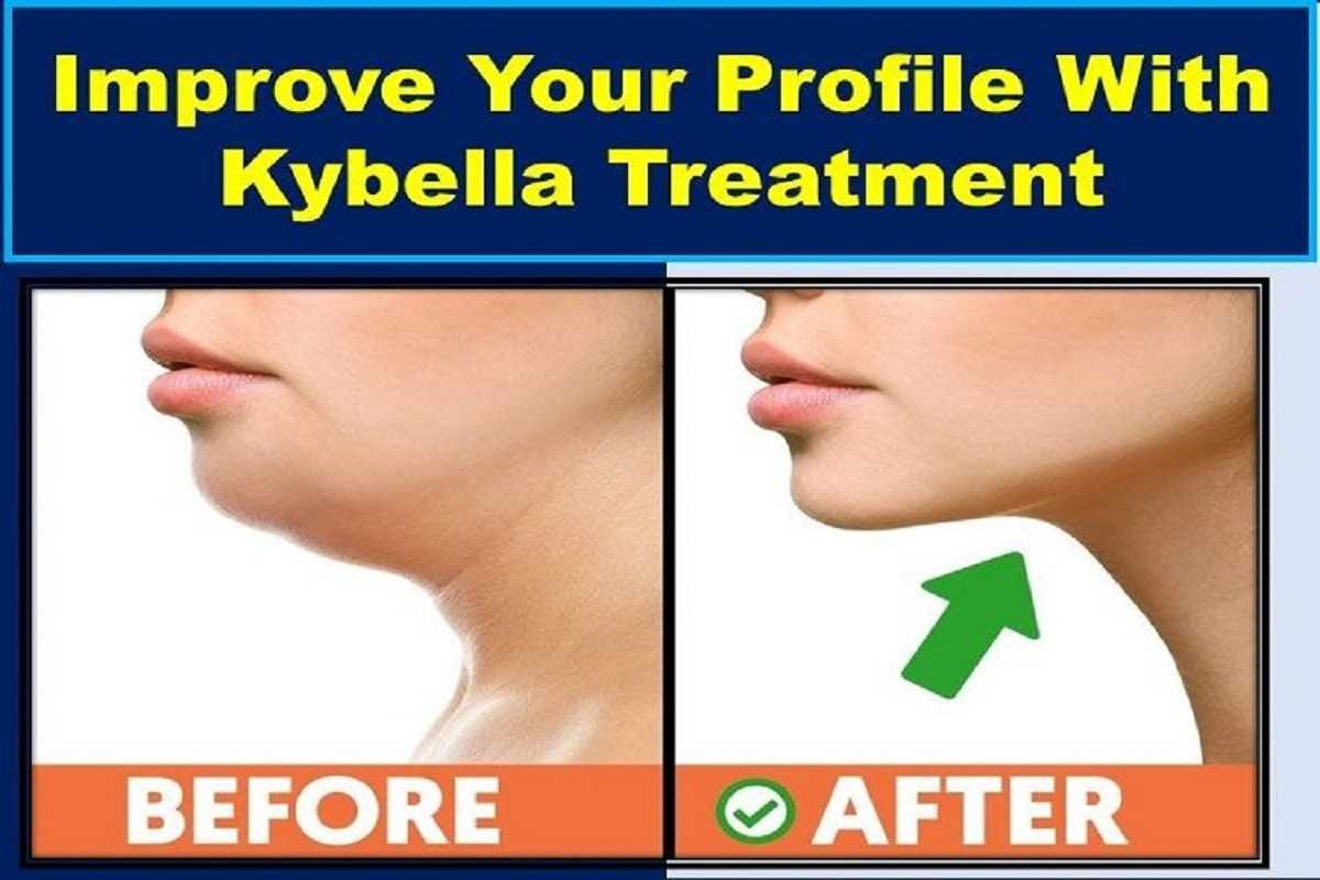 kybella-treatment-before-and-after
