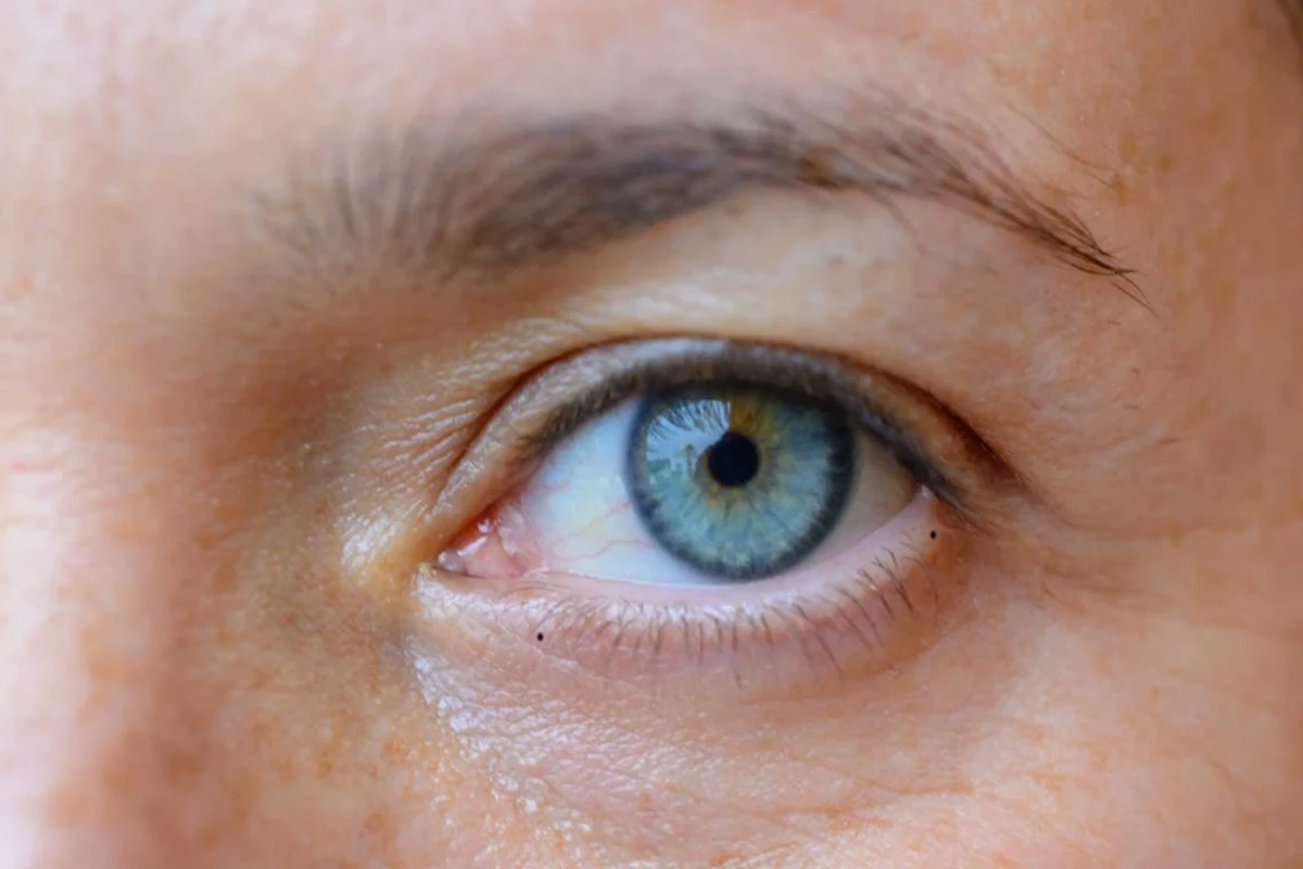 mole-on-eyelid-meaning-mole-on-eye-symbolism-lucky-unlucky