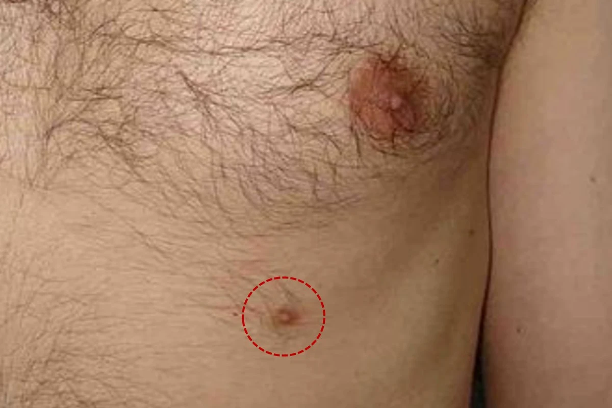 third-breast-third-nipple-spiritual-meaning-power-mythology-causes-removal