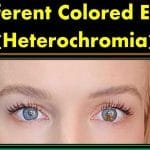 multi two different colored eyes heterochromia farsightedness