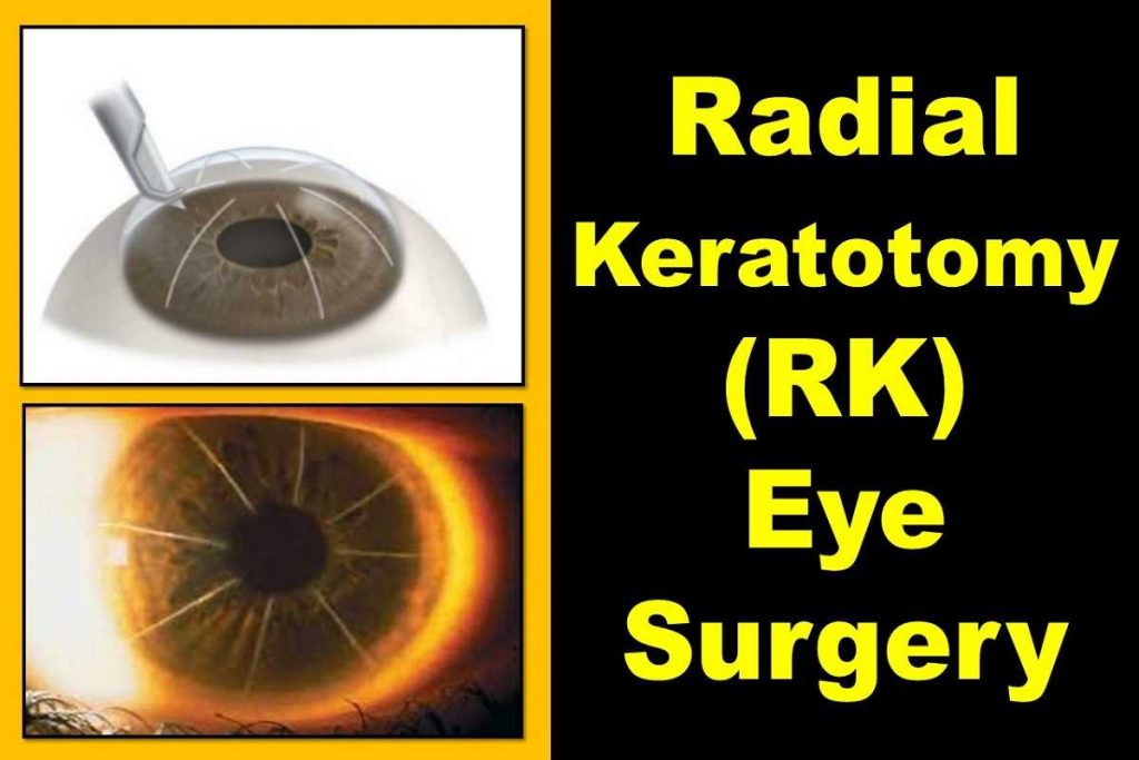 radial-keratotomy-rk-eye-surgery